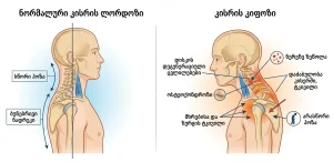 კისრის კიფოზი